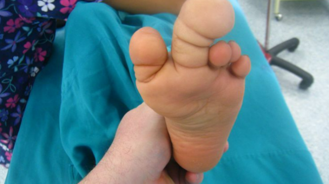 Makrodaktili hastalığı nedir? El ve ayakta görülen bu belirtilerle başlıyor